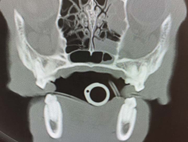 Computerized Tomography (CT)